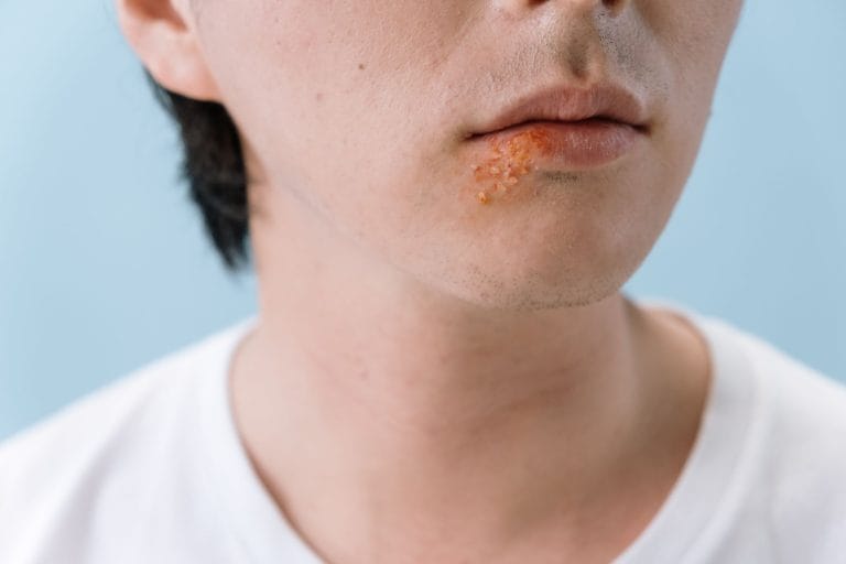 Home Remedies for Herpes: 15 Natural Ways to Soothe Outbreaks