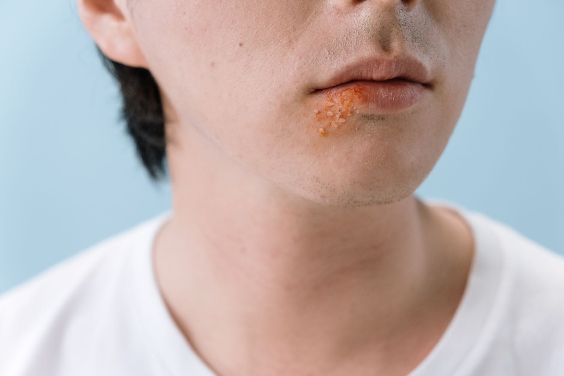 Home Remedies for Herpes: 15 Natural Ways to Soothe Outbreaks