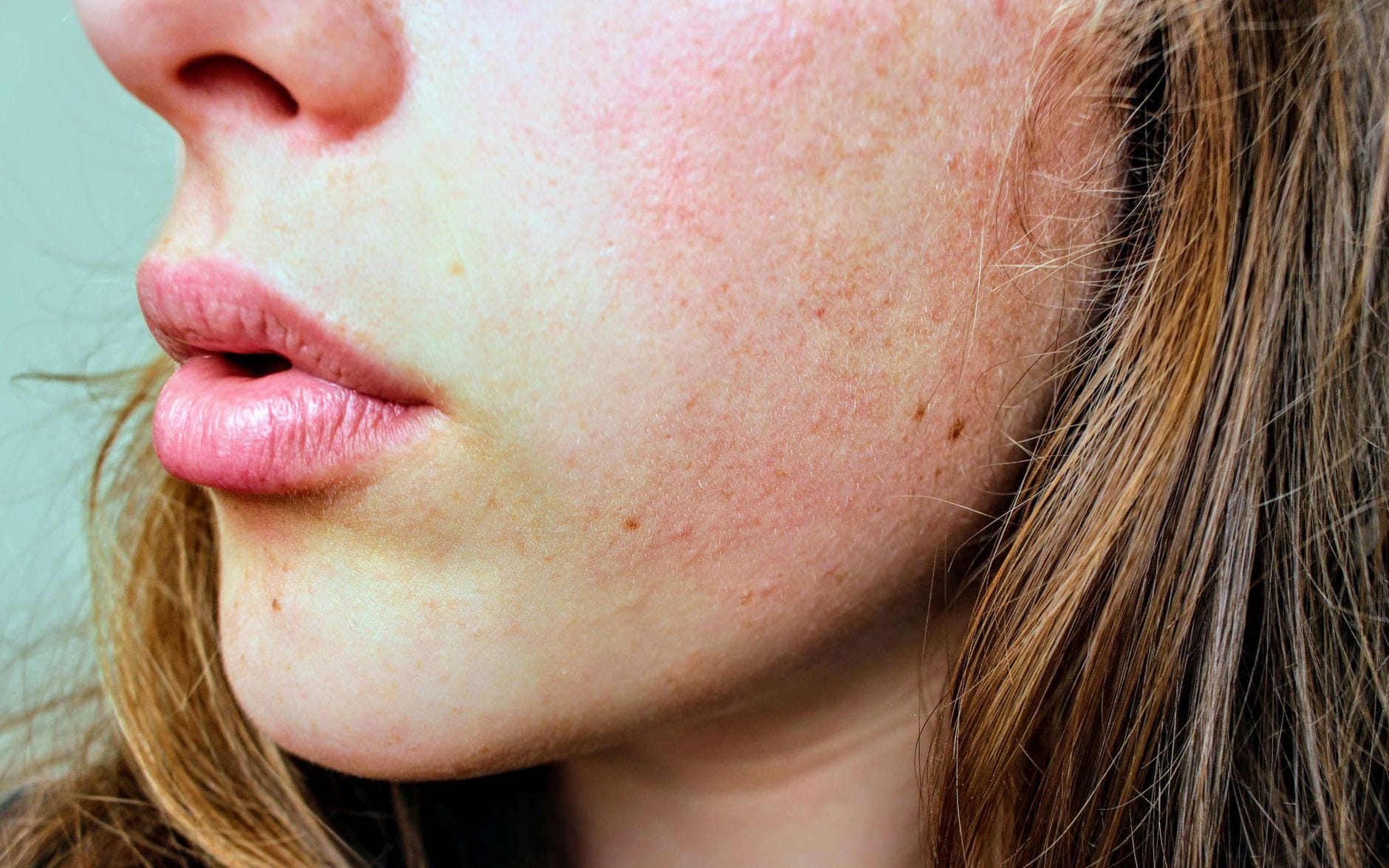 close-up of dry cracked lips on a person's face